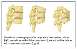 signs of osteoporosis